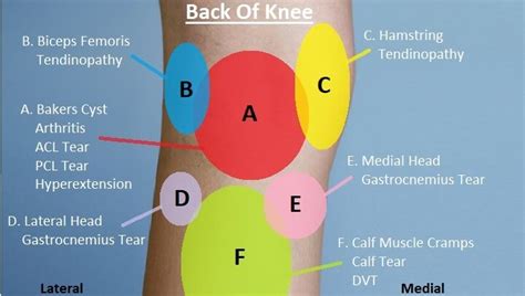 Knee Pain Diagnosis Chart - Knee Pain Explained