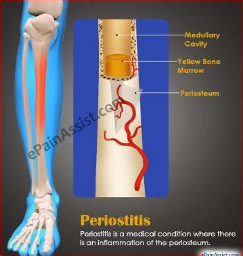 What is Periostitis? Causes and Treatment