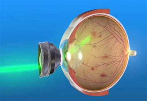 Retinal Laser Photocoagulation: Purpose, Procedure, Risks