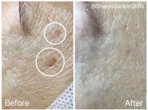 Seborrheic Keratosis — Sharon Gordon SKIN