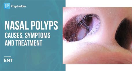 NASAL POLYPS : Causes, Symptoms and Treatment : NEET PG ENT