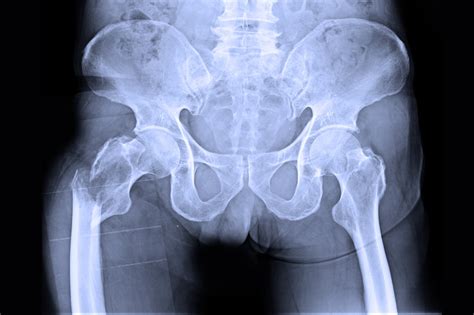 Decreased Osteoporosis Treatment Initiation Observed After Hip Fracture ...