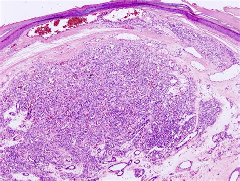 Pathology Outlines - Hemangioma