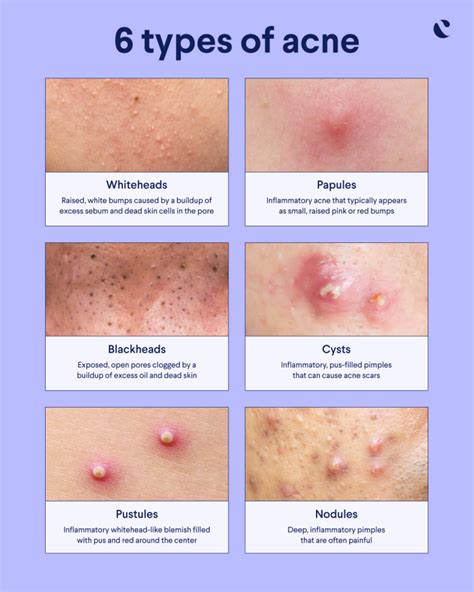 How To Treat Every Type Of Acne Comedones Nodules Cysts – NBKomputer