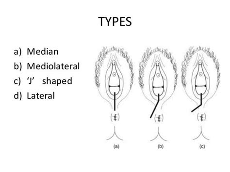 Episiotomy