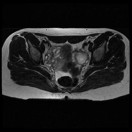 Ovarian dermoid cyst - MRI | Image | Radiopaedia.org