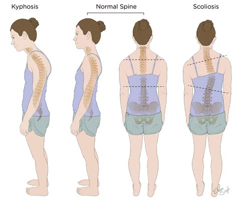 Kyphosis/Scoliosis - Goodman Campbell