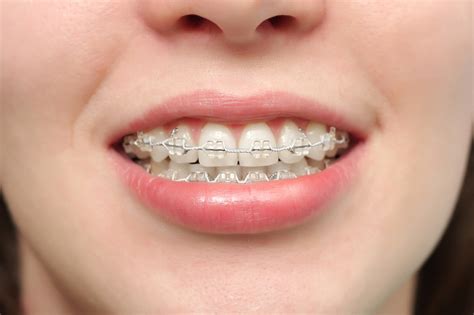 How Much Do Braces Cost in the UK? - The Dental Guide