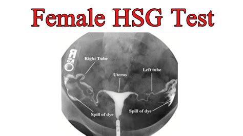 HSG Test - YouTube