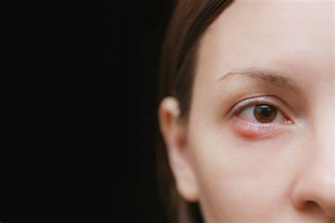 Chalazion: Symptoms, Causes, Treatments & More | MyVision.org