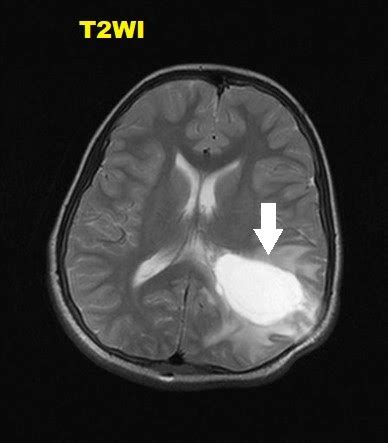 Pleomorphic xanthoastrocytoma (PXA) : MRI - Sumer's Radiology Blog