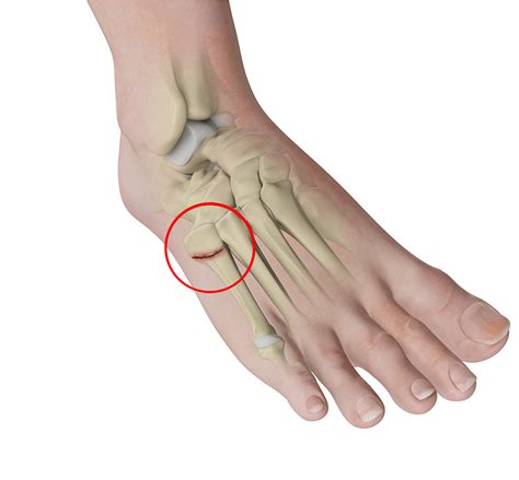 Jones Fractures (5th Metatarsal) Glendale | Metatarsal Cuboid Joint CA