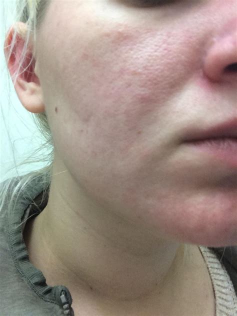 [routine help] always had red blotchy skin. Am i doomed to this or is ...