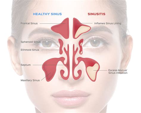 Maxillary And Ethmoid Sinus Disease