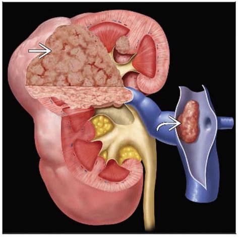 Renal Cell Carcinoma | Radiology Key