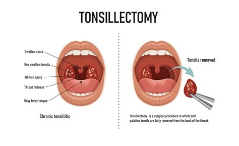 Tonsillectomy - 150 Harley Street ENT