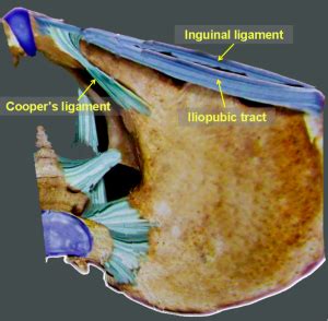 Iliopubic Tract Vs Inguinal Ligament