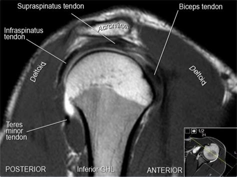 MRI Musculo-Skeletal Section: MRI anatomy of the shoulder (sagittal view).