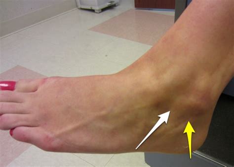 Ankle Instability | Dr Geier