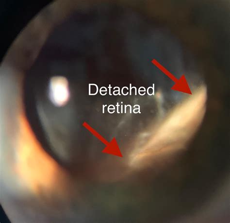 Retinal Detachment Treatment