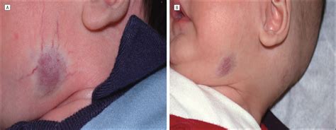 Congenital Hemangiomas | JAMA Facial Plastic Surgery | The JAMA Network