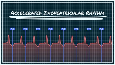 What Accelerated Idioventricular Rhythm Looks Like on Your Watch ECG | Qaly