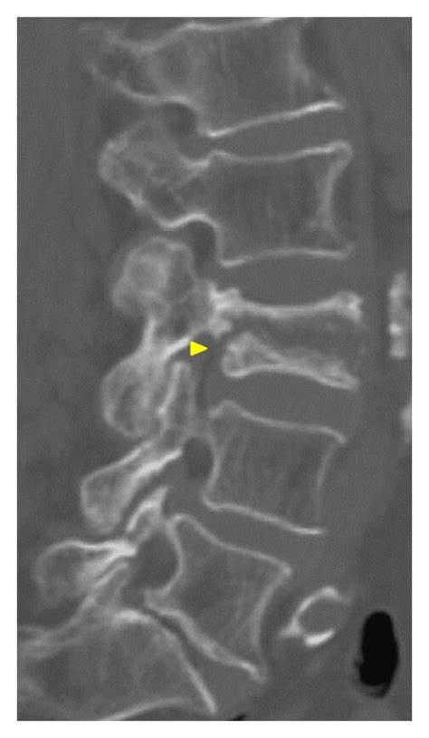 The 85-year-old woman with an L3 vertebral body fracture, detected two ...