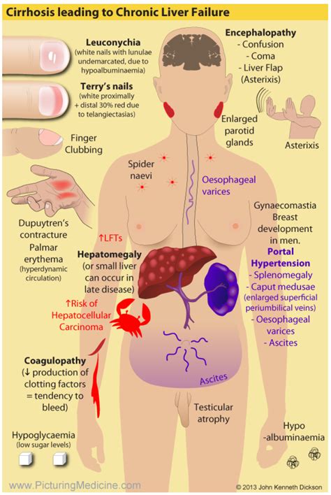 Liver Disease & Diet for Health