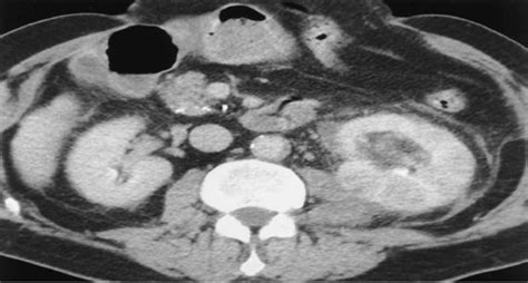 CT scan acute pyonephritis (literature) | Download Scientific Diagram