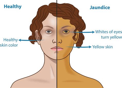 Yellow Skin (Jaundice): Pictures, Symptoms, Causes, and Diagnosis