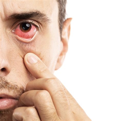 Eye Bleeding(Hyphema): Causes, Symptoms and Treatment – sightconnection