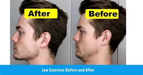 Jaw Exerciser Before and After – JawFlex®