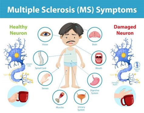 Download Multiple Sclerosis (ms) Symptoms Information Infographic for ...