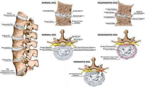 Intervertebral disc anatomy, function, degeneration, herniation