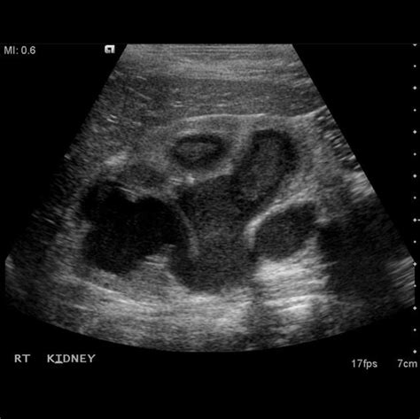 Pin by Ian Bickle on Urogenital Radiology | Vascular ultrasound ...