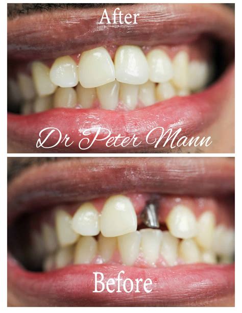 Dental Implants before and after photo | Manhattan | Dentist