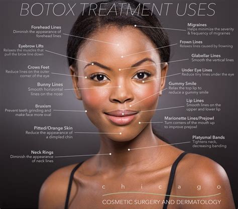 Botox Injection Face Diagram | Botox, Botox fillers, Facial aesthetics