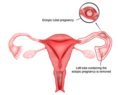 Chapter 26 – Laparoscopic Surgery for Ectopic Pregnancy – Melaka Fertility