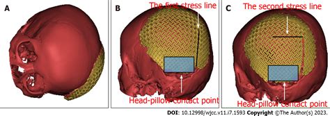 Spontaneous fracture of a titanium mesh cranioplasty implant in a child ...