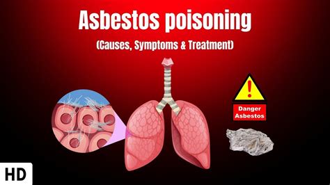 Asbestos Poisoning: Causes, Symptoms and Treatment - YouTube