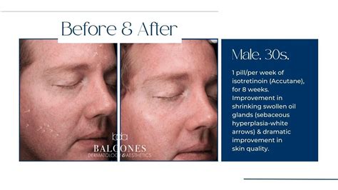 Accutane Before & After Gallery - Austin, TX: Balcones Dermatology ...