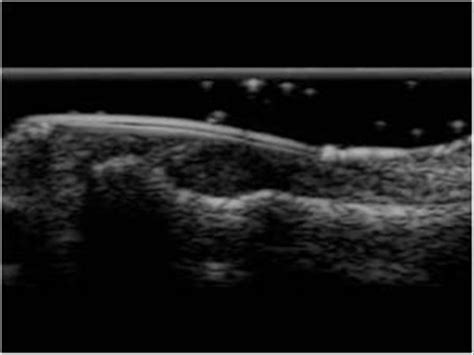 Musculoskeletal Joints and Tendons | 6.4 Fingers : Case 6.4.5 Tumors ...