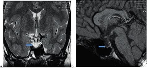 MRI brain scans of patient number 2 confirming the diagnosis of empty ...