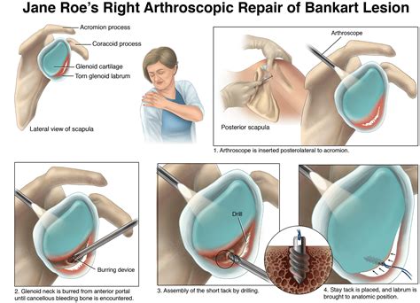 Bankart Lesion Repair on Behance