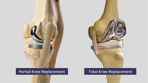 Robotic Knee Replacement