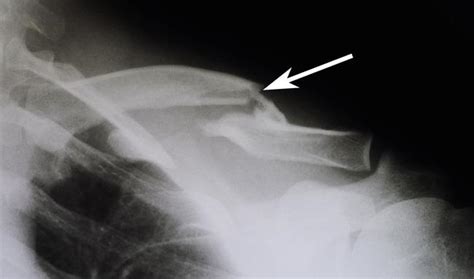 Clavicle Fracture (Broken Collarbone) - OrthoInfo - AAOS