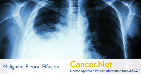 Fluid Around the Lungs or Malignant Pleural Effusion | Cancer.Net