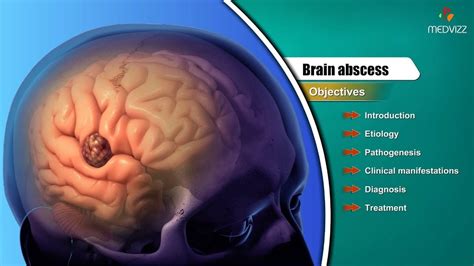 What's "ordinary negligence"?//Missed brain abscess//Special offer