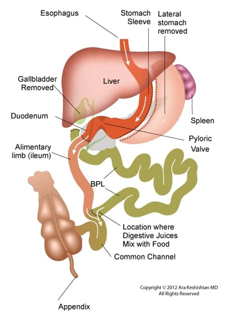 Laparoscopic Duodenal Switch - DSSurgery