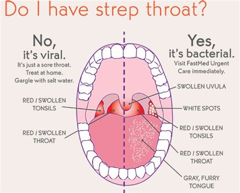 Tonsillitis: Causes, Symptoms, Treatment & Home Remedies » How To Relief